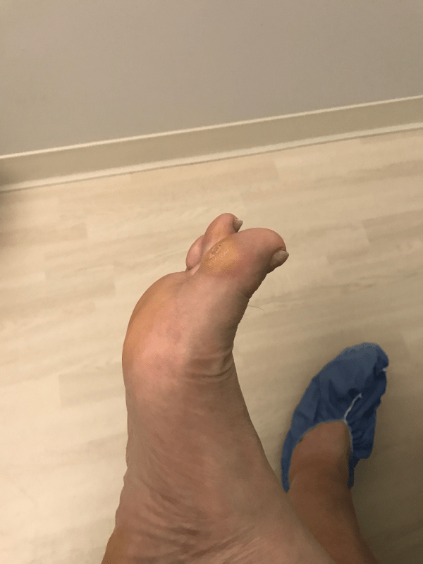 Toe post 02